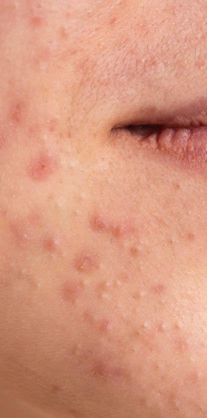 Disease Image